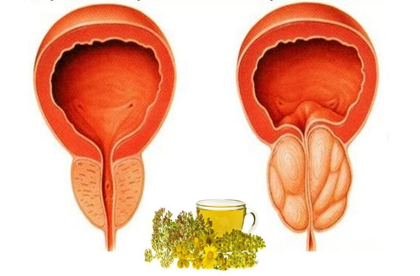 Healthy and sore prostate