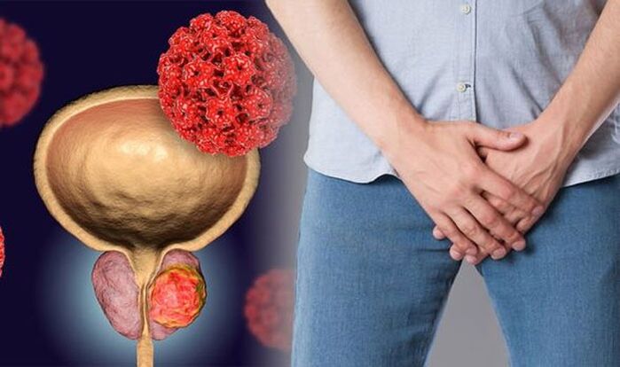 prostatitis